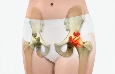 Prothèse totale de hanche