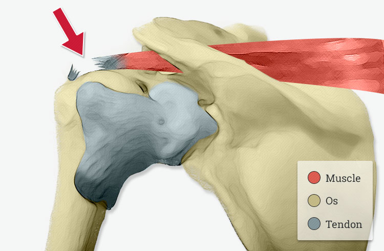 Chirurgie de la rupture de la coiffe des rotateurs