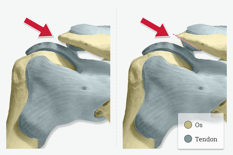 acromioplastie