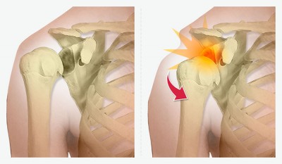 Chirurgie de la luxation de l’épaule