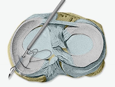 Chirurgie du ménisque