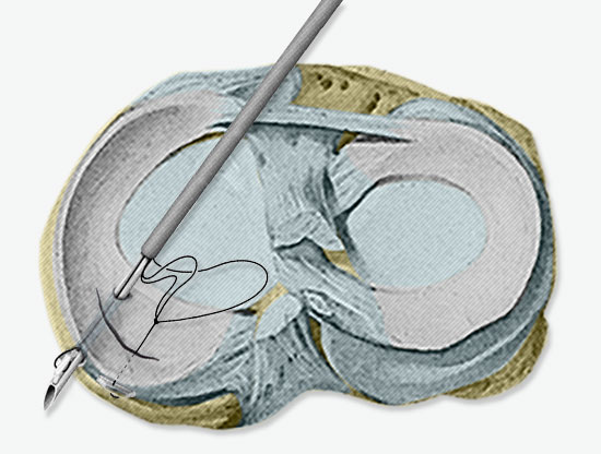 Chirurgie du ménisque - Chirurgie Orthopédique Versailles