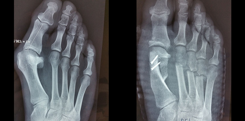 Hallux Valgus