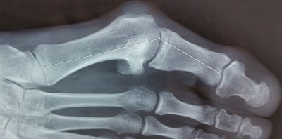 Chirurgie de l’Hallux Valgus