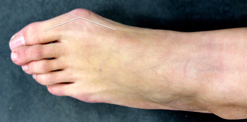 Hallux valgus ambulatoire